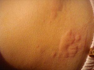 The most common signs of stress rash are the hives. They appear in clusters.