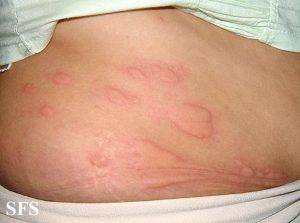Stress can cause your skin to produce more cortisol or adrenaline. You may notice raised red bumps or hives as stress rash symptoms.