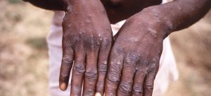 Monkeypox can be prevented by avoiding close skin-to-skin contact with persons with the disease.