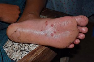 Public health officials in the United States have not yet issued any official guidance on the transmission of monkeypox.